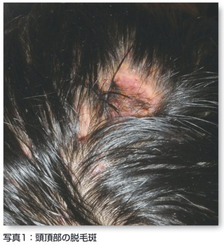 ケルスス禿瘡、頭皮の化膿した部分